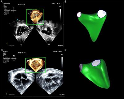 A comparison between the apical and subcostal view for three-dimensional echocardiographic assessment of right ventricular volumes in pediatric patients